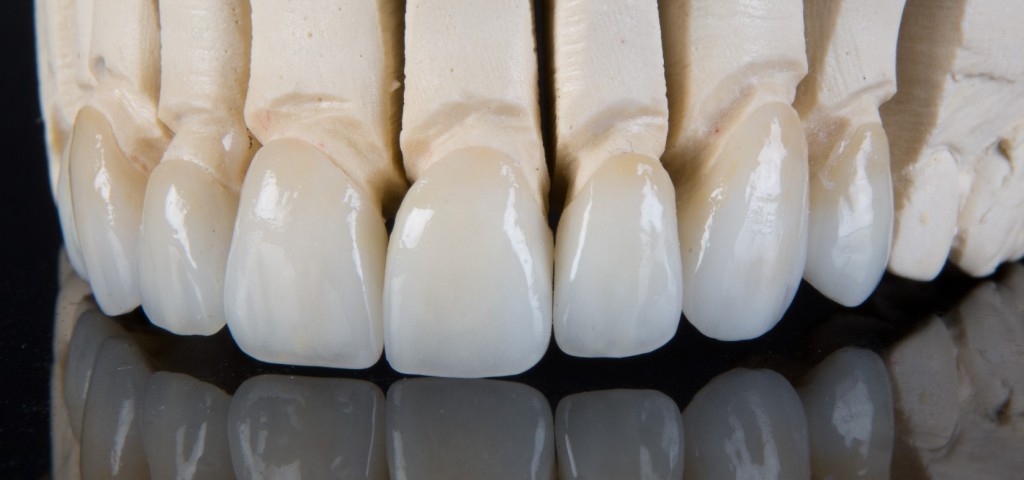 Zubni ispuni i fasete