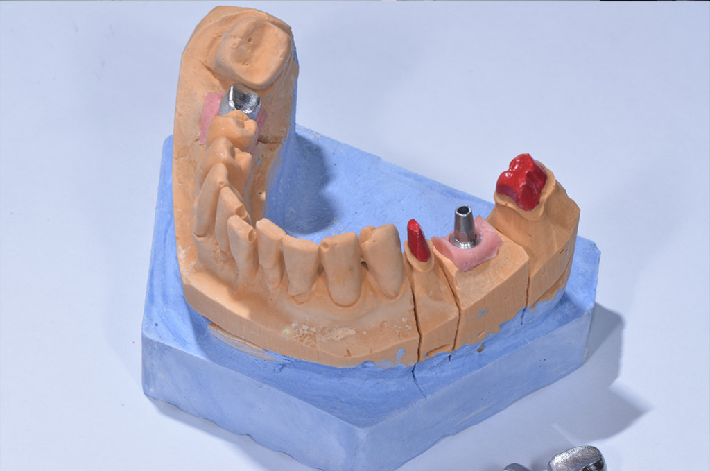 ugradnja implanta zubar beograd
